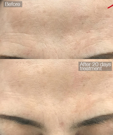 A picture showing a skin patch on the forehead area, the patch fits perfectly with the skin, smoothing out the wrinkles on the forehead and making the skin surface smooth visually