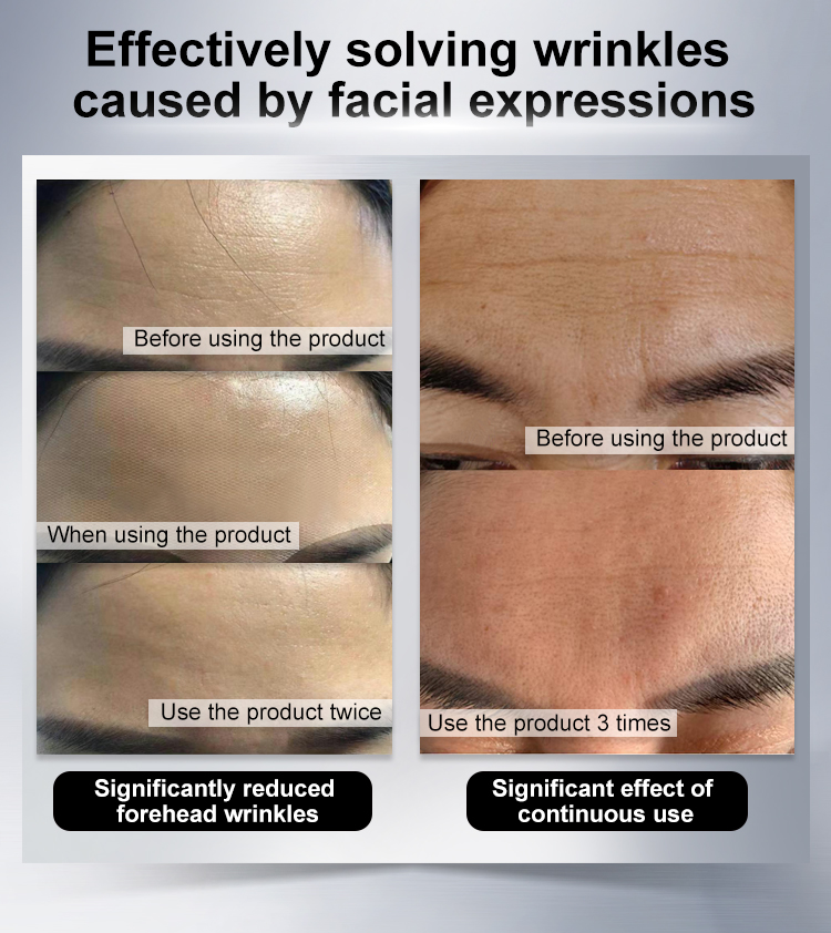 Anti-wrinkle forehead patch usage comparison chart